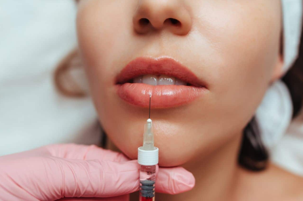 Close-up image showing lip filler migration, where filler has moved beyond the natural lip border, creating a swollen or uneven appearance. Arrows highlight the migrated filler above the upper lip, illustrating the importance of proper injection technique and maintenance.